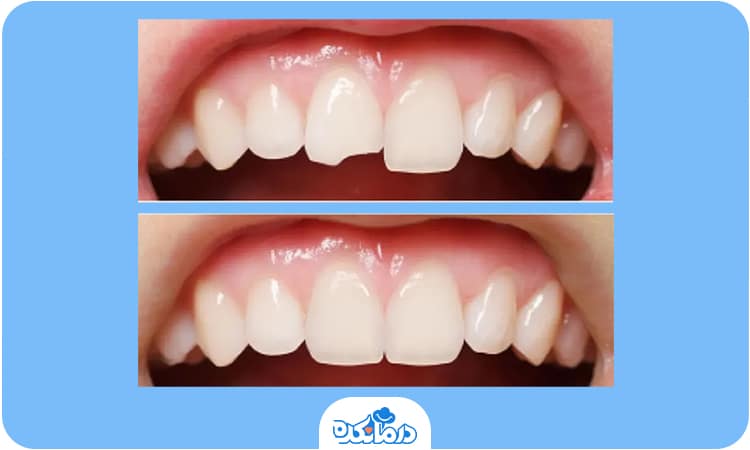 تصویر قبل و بعد کامپوزیت دندان‌شکسته
