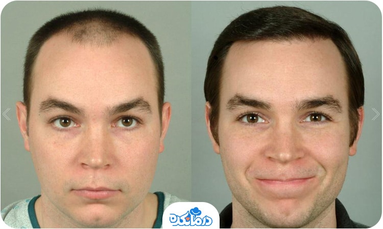 تصویری از قبل و بعد کاشت مو