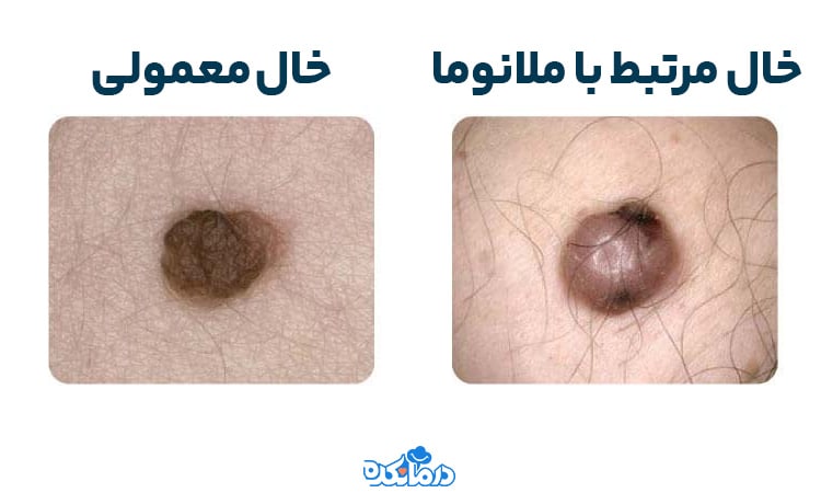 عکس خال های سرطانی