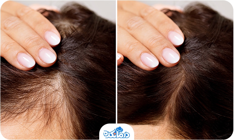 ریزش موی سر را می‌بینید که با مصرف قرص بیوتین می‌تواند درمان شود.