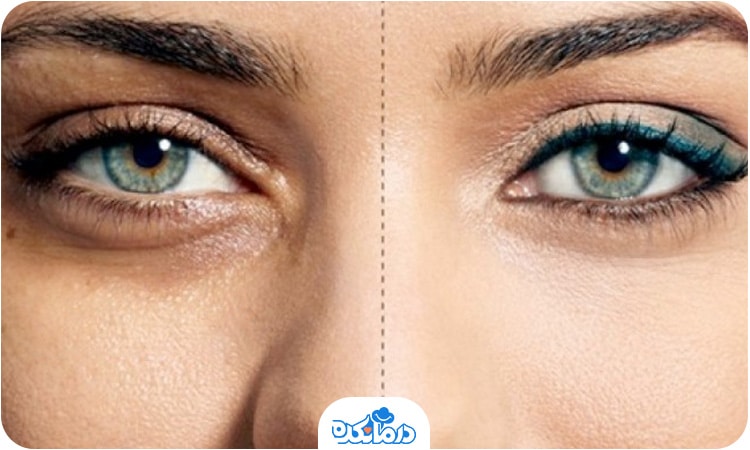 تصویر قبل و بعد کربوکسی‌تراپی زیر چشم