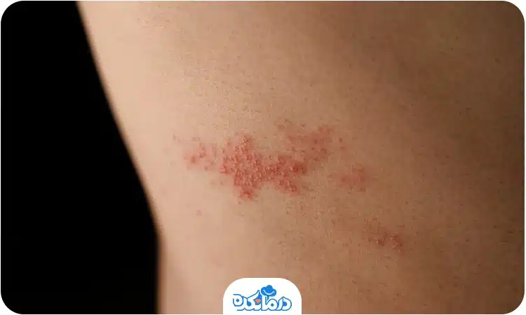تصویر بثورات پوستی زونا روی کمر