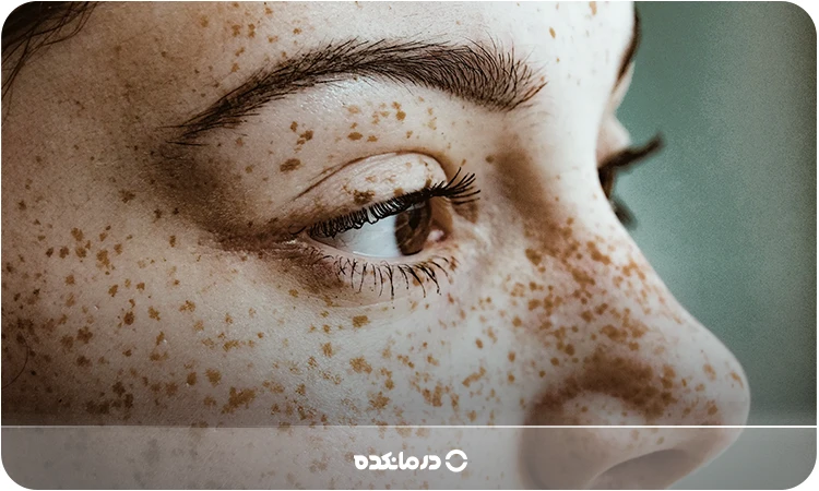 تصویر یک فرد مبتلا به ککومک