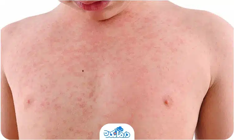 کهیر پوستی را می‌بینید که می‌تواند از علائم آلرژی کودکان باشد.