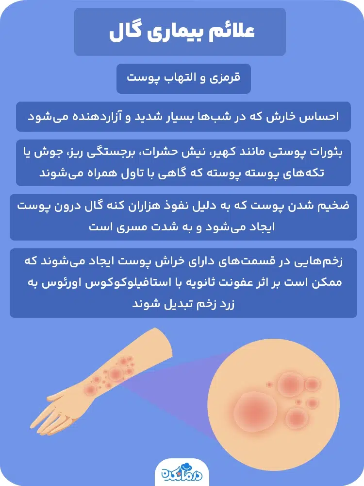 بیماری گال چیست؟ بررسی نشانههای خوب شدن این بیماری