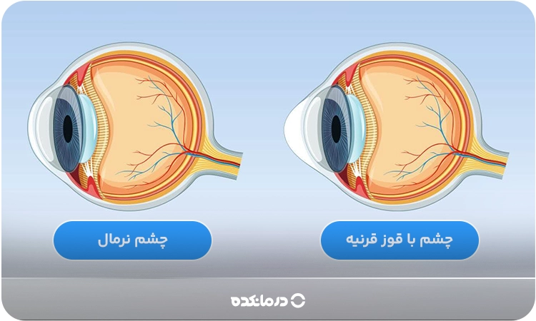 یک تصویر گرافیکی ساده که شکل طبیعی قرنیه و قرنیه مبتلا به قوز قرنیه را در کنار هم نشان میدهد
