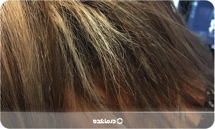 تصویری از موهای سوختهشده توسط دکلره