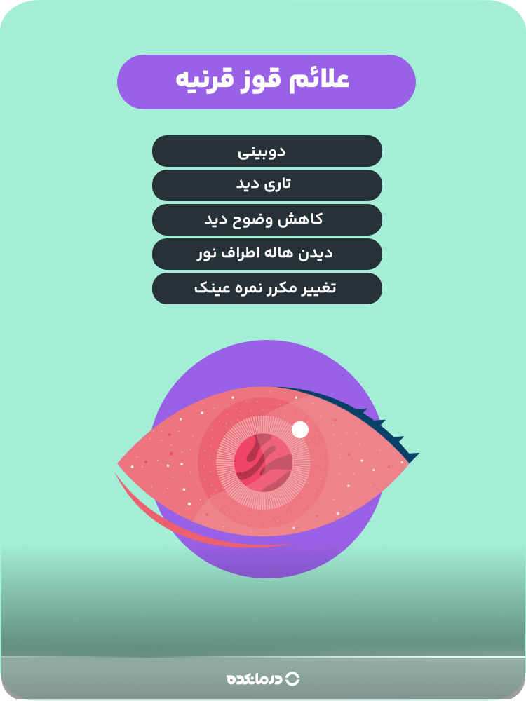 علائم قوز قرنیه: تاری دید ، دوبینی ، تغییر مکرر نمره عینک ، کاهش وضوح دید، دیدن هاله اطراف نور
