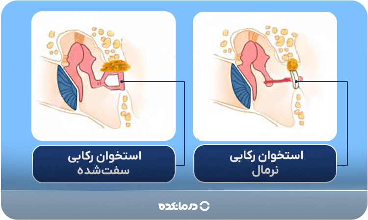 طرح شماتیک از استخوان رکابی سفتشده در اثر اتواسکلروزیس (مقایسه بین حالت سالم و حالت بیحرکتشده)