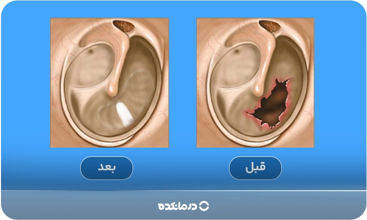 تصویری از ترمیم پرده گوش به صورت قبل و بعد