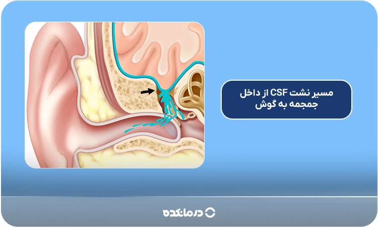 نمای شماتیک از مسیر نشت CSF از داخل جمجمه به گوش