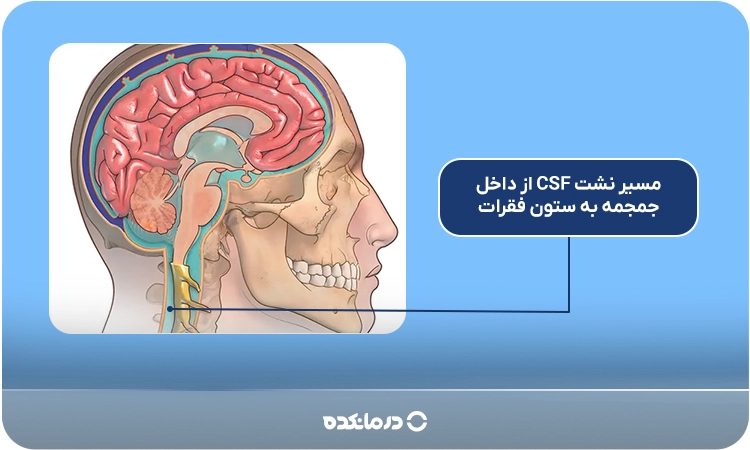 نمای شماتیک از مسیر نشت CSF از داخل جمجمه به ستون فقرات