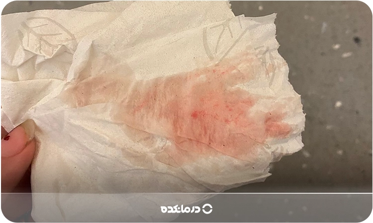 عکس لکه بینی در بارداری به دلیل لانه گزینی  (لکه‌بینی صورتی روشن روی دستمال کاغذی)
