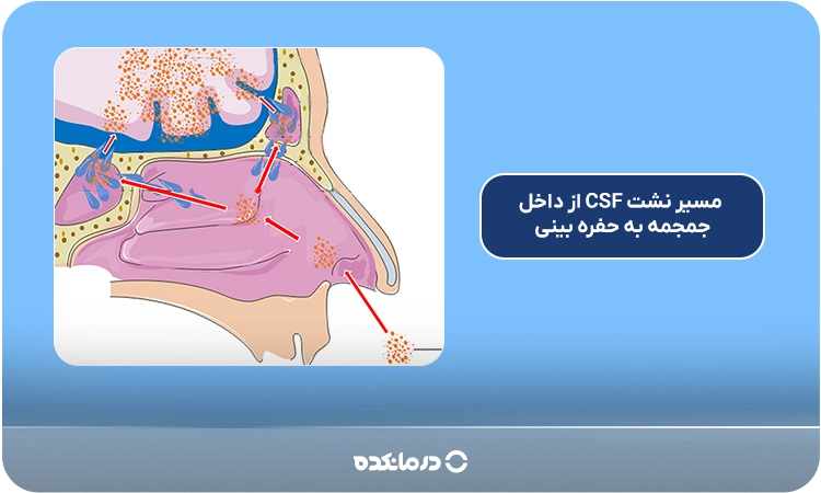 نمای شماتیک از مسیر نشت CSF از داخل جمجمه به حفره بینی