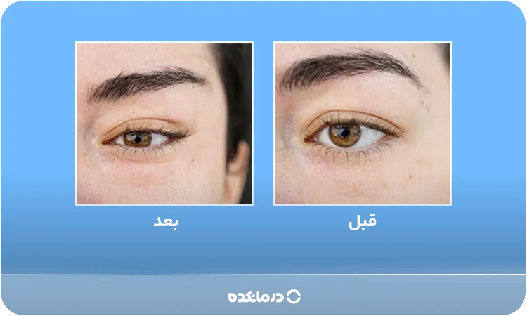 عکس قبل و بعد بوتاکس چشم گربهای