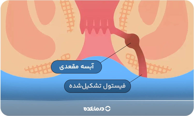 تصویر گرافیکی بیماری آبسه مقعدی و فیستول تشکیل‌شده در اثر آن را می‌بینید