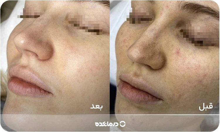 عکس قبل و بعد کربن تراپی صورت