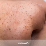 عکس جوش سر سیاه