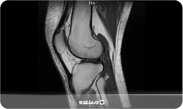 عکس MRI مربوط به پاره شدن مینیسک زانو