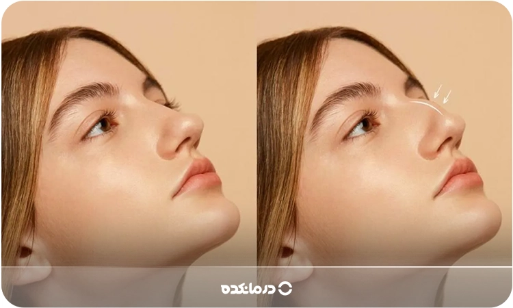 پل بینی قلابدار را میبینید.