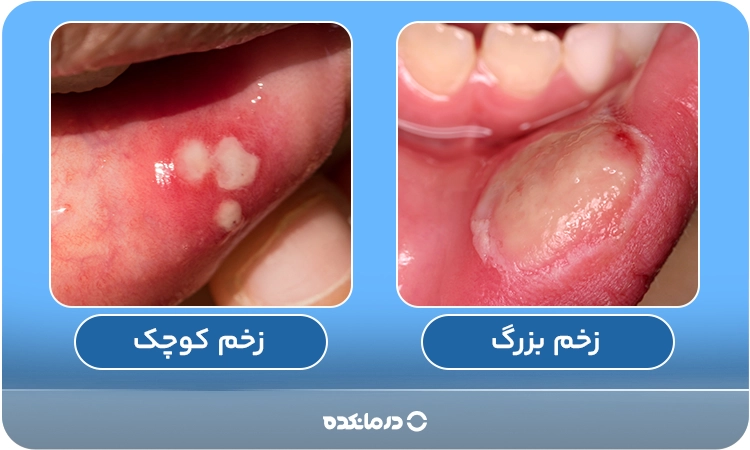 عکس زخم بزرگ و زخم کوچک دهان رامی بینید