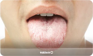 کمبود کدام ویتامین باعث خشکی دهان می‌شود؟