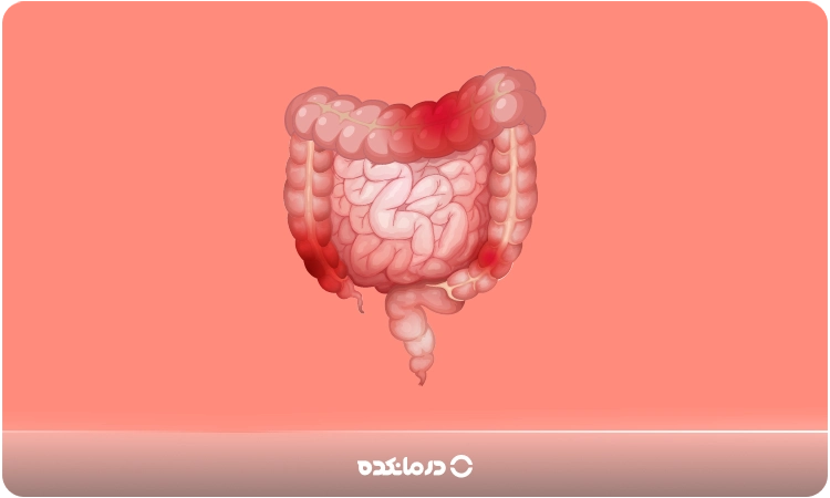 تصویر گرافیکی از روده بزرگ که ملتهب است را می بینید