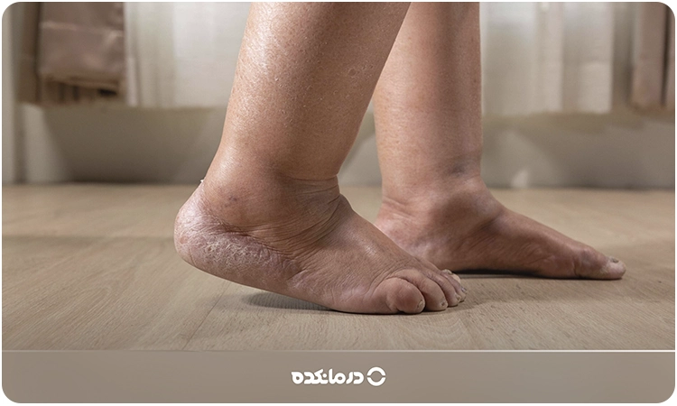 تصویر ورم در ناحیه مچ پا تا ساق پا را میبینید
