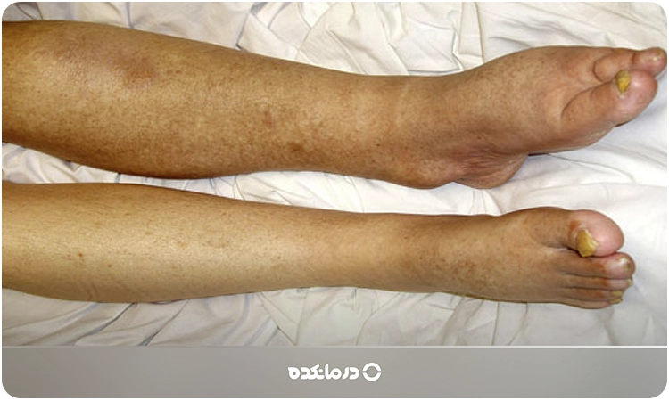تصویر لنف ادم در ناحیه مچ پا را میبینید.