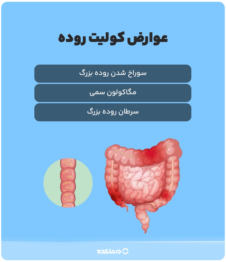 اینفوگرافیک عوارض کولیت روده