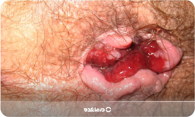 شکل بواسیر خونی