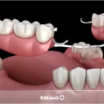 پروتز دندان [ثابت و متحرک] چیست؟ انواع + ۹ مزایا و عوارض