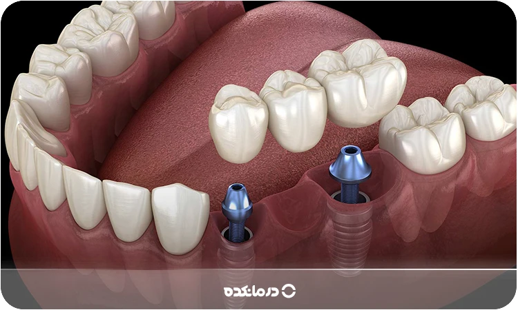 تصویر بریج یا پل دندان را می بینید