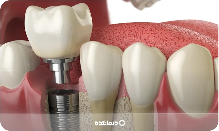 تصویر ایمپلنت دندان را می بینید