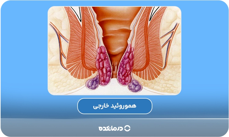 تصویر گرافیکی از هموروئید خارجی را می بینید