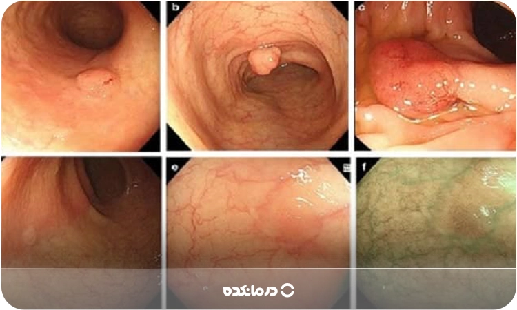 چند تصویر از هموروئید داخلی خفیف در اندازه و جاهای مختلف رکتوم را می‌بینید