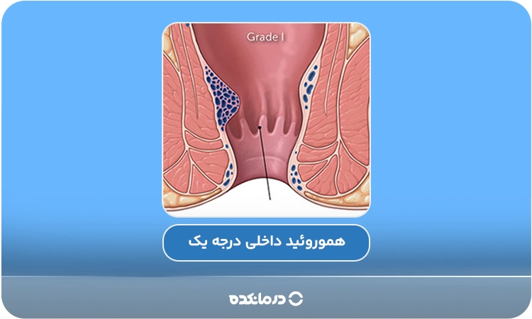 تصویر گرافیکی از هموروئید داخلی درجه یک را می‌بینید