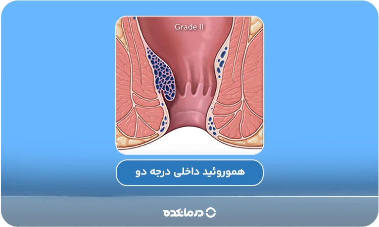 تصویر گرافیکی هموروئید داخلی درجه ۲ را می‌بینید