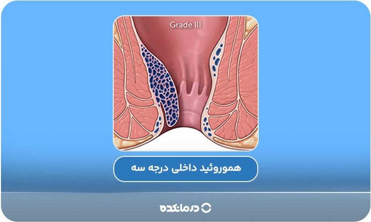 تصویر گرافیکی از هموروئید داخلی درجه ۳ را می‌بینید