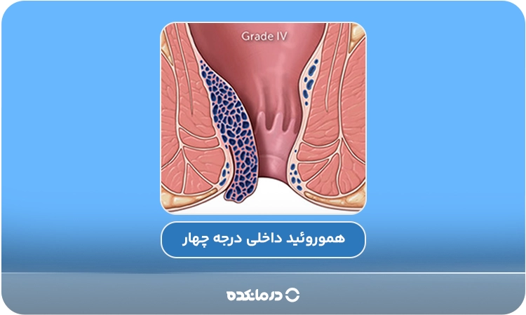 تصویر گرافیکی از هموروئید داخلی درجه ۴ را می‌بینید