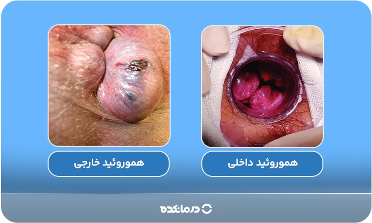 تصویر بواسیر داخلی و بواسیر خارجی را در کنار هم می‌بینید