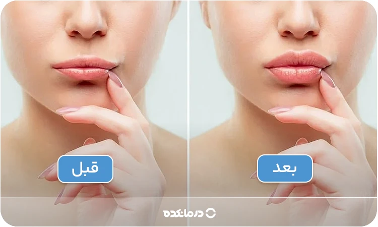 تصویری از لبها قبل و بعد از بوتاکس را میبینید