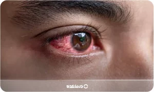 سکته چشمی چیست؟ [علت، انواع و علائم + ۶ روش درمان]