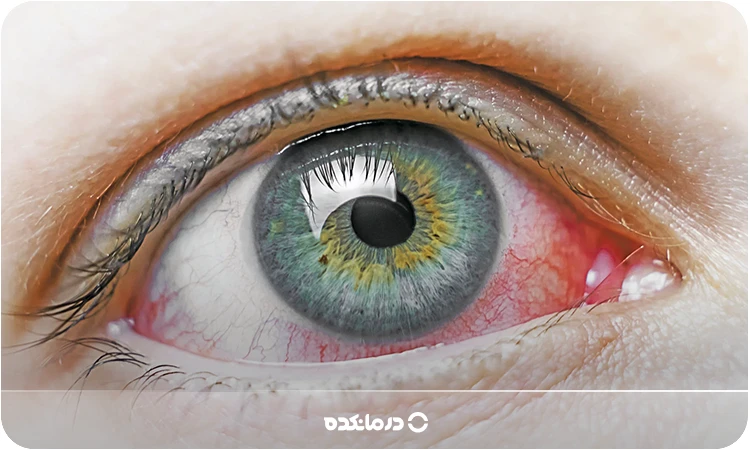 تصویری از چشم با رگههای قرمز را میبینید