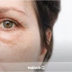 پف زیر چشم؛ [۷ علت شایع + ۴ روش درمان قطعی]