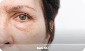 پف زیر چشم؛ [۷ علت شایع + ۴ روش درمان قطعی]