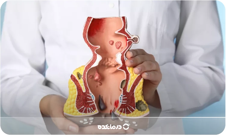 دشمن بواسیر [چه بخوریم تا بواسیر از بین برود؟]