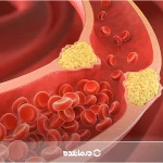 برای کاهش سریع چربی خون چه بخوریم؟ [۱۹ خوراکی شفابخش]