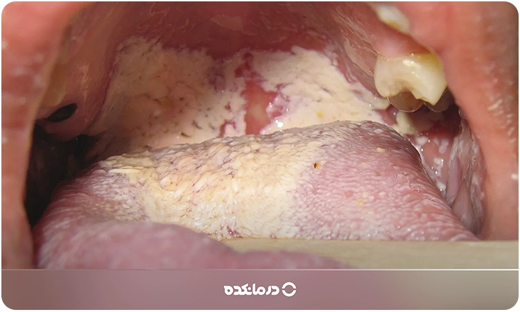 تصویری از برفک دهان از نزدیک