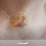 کبودی گردن؛ علت، عوارض + ۵ ژل و پماد برای رفع کبودی فوری